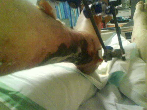 my_leg_injuries_2__by_lightningtremlett.jpg